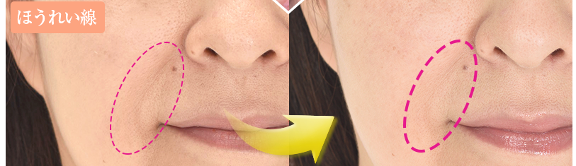 ほうれい線を化粧品で目立たなく!