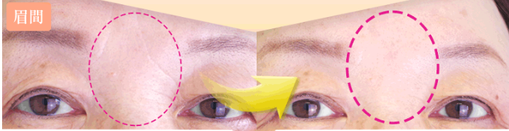 ほうれい線を化粧品で目立たなく!